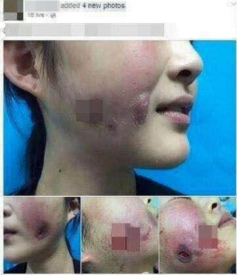 Mặc dù các trường hợp "thủng mặt" vì làm má lúm đã được cảnh báo không ít lần nhưng dường như trào lưu này vẫn đang rất thịnh hành. Ảnh trong bài: Internet.