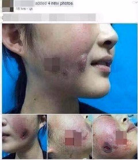 Mặc dù các trường hợp "thủng mặt" vì làm má lúm đã được cảnh báo không ít lần nhưng dường như trào lưu này vẫn đang rất thịnh hành. Ảnh trong bài: Internet.