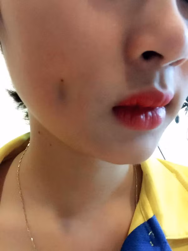 Theo lời tâm sự của cô gái, sau 2 tháng làm má lúm thì phát hiện vùng má bị sưng, nguyên nhân được bác sỹ kết luận là do viêm nhiễm, có mủ bên trong vì chỉ khâu là chỉ ni lông, không tiêu, nếu không phẫu thuật kịp thời sẽ có thể bị hoại tử. Được biết mức giá cho ca nhấn má chỉ vỏn vẹn 500 nghìn.