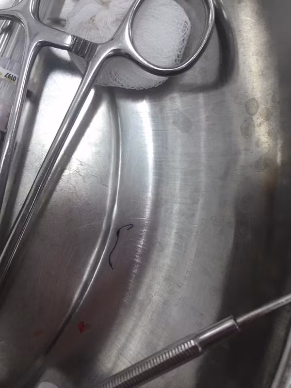 Không muốn phải chịu đau đớn, nạn nhân của cuộc phẫu thuật thẩm mỹ má lúm đã phải đến viện để giải quyết hậu quả. Ảnh cô chụp lại sợi chỉ mà các bác sỹ lấy ra trong má của cô.