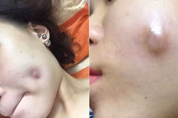 Hậu quả phẫu thuật thẩm mỹ được cô gái không ngần ngại chia sẻ và nhắc nhở mọi người, nếu làm đẹp nên lựa chọn bệnh viện uy tín, đừng vì tâm lý ham rẻ mà “tiền mất tật mang”.