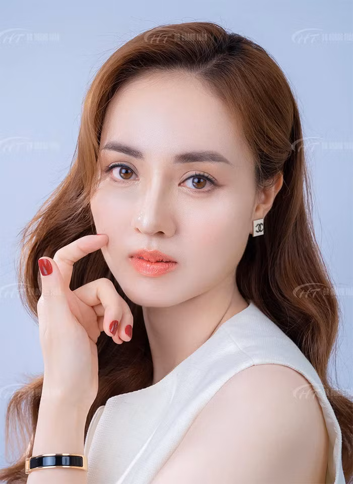 Ngọc Hà cho biết cô từng sửa mũi cách đây 14 năm nhưng hiện tại dáng mũi này không thấy phù hợp nữa nên quyết tâm chỉnh sửa lại. (Ảnh: FB Hoàng Thanh Tuấn)