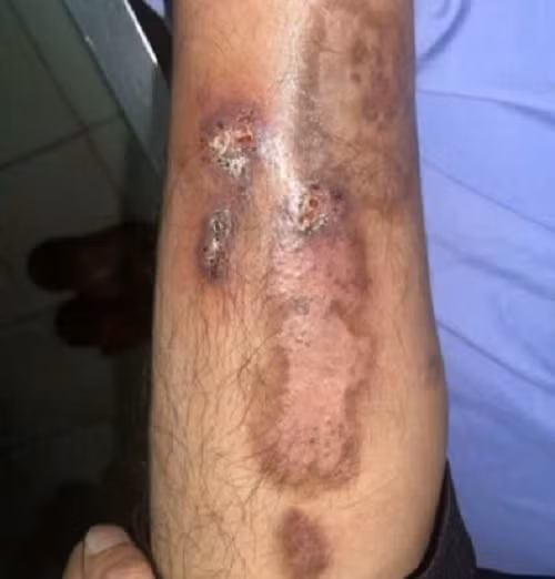 Nguoi dan ong lo loet chan suot 2 nam, nam Candida la “thu pham“