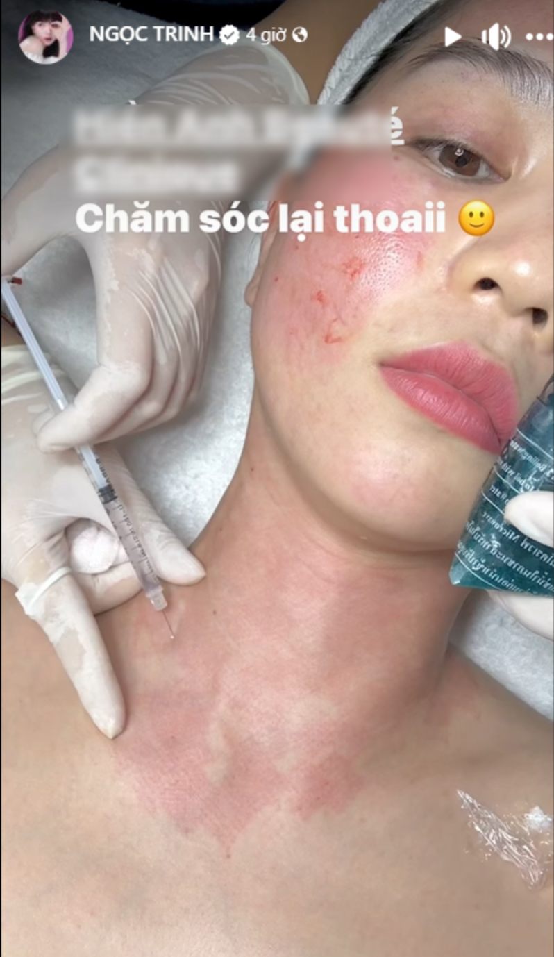 Vào đầu tháng 8/2024, Ngọc Trinh đăng tải hình ảnh tận hưởng dịch vụ chăm sóc sắc đẹp lên trang cá nhân. Được biết, cô sử dụng dịch vụ tiêm chất có lợi vào làn da, giúp da luôn giữ được độ đàn hồi, căng mướt và sáng mịn. Ảnh: FB NGỌC TRINH
