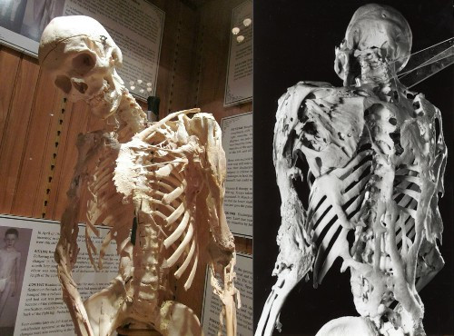 Một số phương pháp điều trị như phẫu thuật cắt bỏ xương mới phát triển nhưng cũng ít mang hiệu quả, thậm chí cắt chỗ này thì chỗ kia lại phát triển.