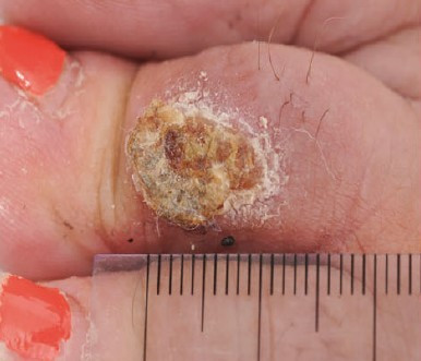 Bạch hầu da thường gặp ở những vùng nhiệt đới có thể do nơi đây tỉ lệ bệnh lưu hành cao hơn và nhiều người có miễn dịch tự nhiên với bệnh.