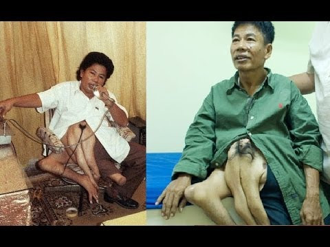 Rudy Santos, 69 tuổi đến từ Philippines, bị chứng cực kỳ hiếm có tên khoa học là “Craniopagus parasiticus” hoặc ký sinh đôi. Gắn liền với xương chậu và bụng của Rudy là một cặp cánh tay và một chân. cùng với đó là một cặp núm vú và đầu chưa phát triển với một bên tai và tóc.