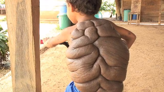 Cậu bé Didier Montalvo, 6 tuổi bị mắc một chứng bệnh hiếm gặp có tên gọi là Congenital Melanocytic Nevus nên được gọi là “người rùa” bởi những khối u khổng lồ phía sau lưng cậu bé trông như một "chiếc mai rùa".