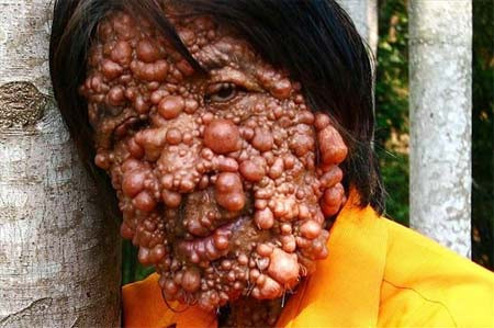 Người đàn ông bất hạnh này tên Chandra Wisnu đã bị một căn bệnh quái ác hành hạ suốt 30 năm. Với những bong bóng khắp cơ thể ông đã sống khép mình và không còn muốn giao tiếp với ai.