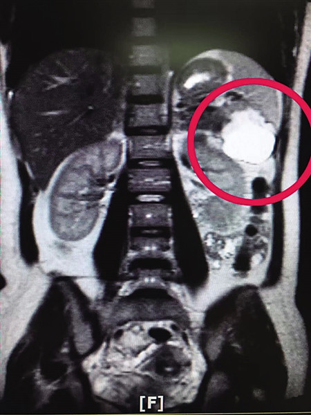 Hoang hon phat hien bao thai lac tren la lach