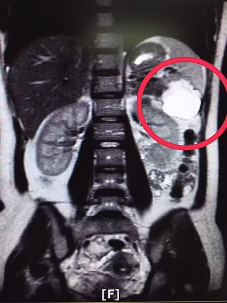 Hoang hon phat hien bao thai lac tren la lach