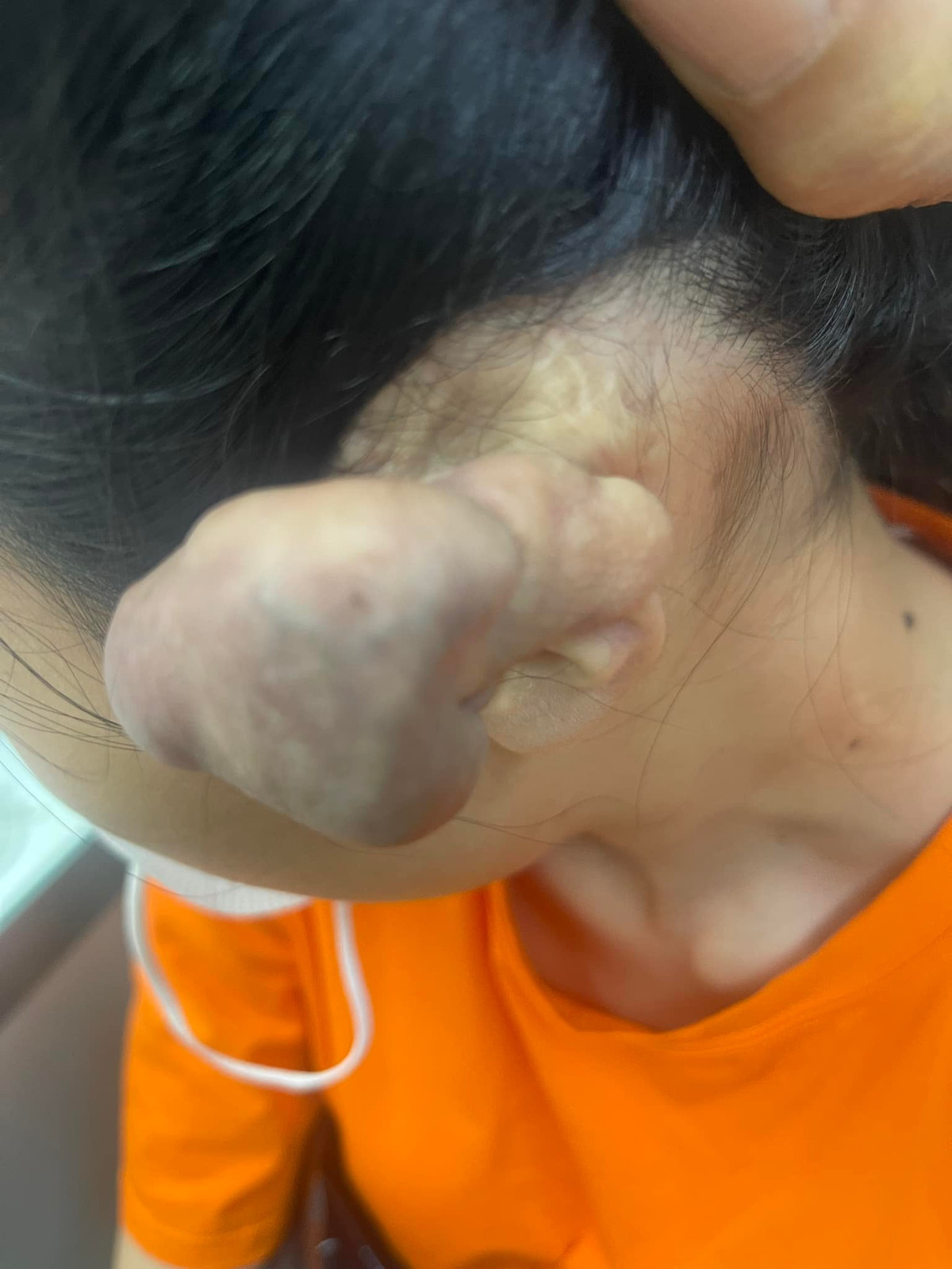 3 lần phẫu thuật u khủng vì bấm 6 lỗ tai cho “chất” 3 lan phau thuat u khung vi bam 6 lo tai cho “chat”