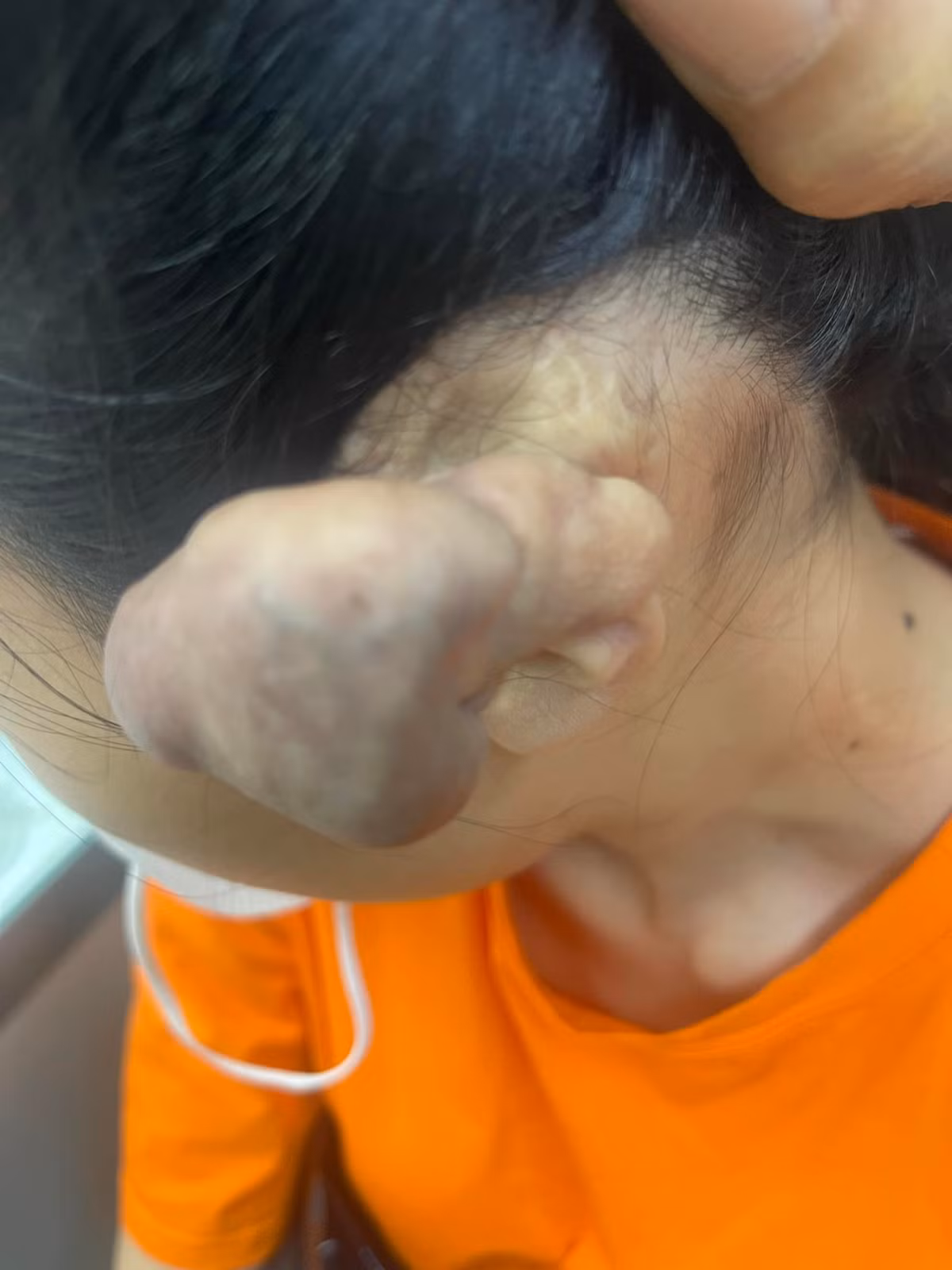 3 lan phau thuat u khung vi bam 6 lo tai cho “chat”