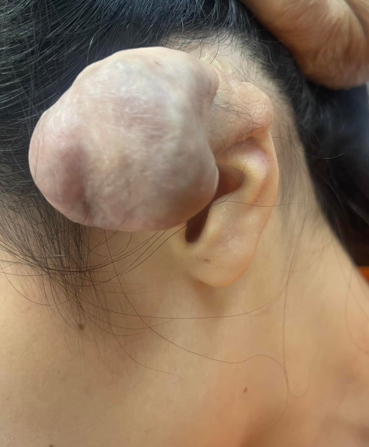 3 lần phẫu thuật u khủng vì bấm 6 lỗ tai cho “chất” - Hình 2 3 lan phau thuat u khung vi bam 6 lo tai cho “chat”-Hinh-2