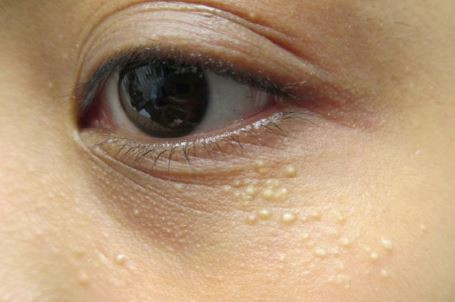 Không cần dùng tia laser mụn thịt cũng bay hết với lá này Khong can dung tia laser mun thit cung bay het voi la nay