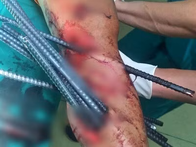 Kinh hoang: Va cham voi xe ba gac, thanh nien bi 11 thanh sat dai dam xuyen chan