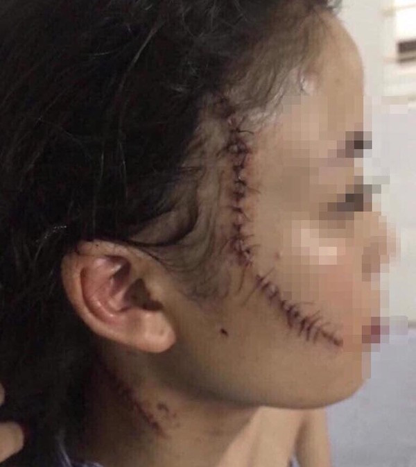 Dang ngoi choi, thieu nu 18 tuoi bat ngo bi nhom ban cu xong vao rach mat