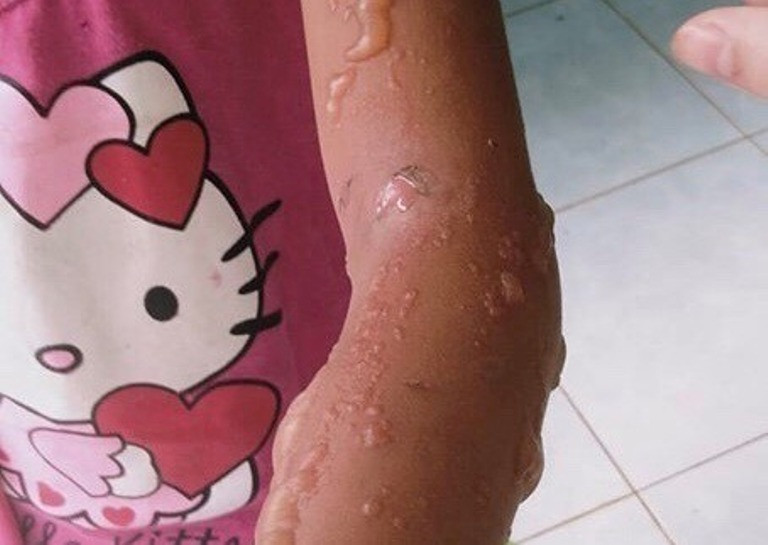 Do đi bắt, thu mua loại bọ 3 sọc để bán, đã có một số người phải nhập viện vì những triệu chứng như bỏng ngứa, nóng sốt. Ảnh: Dân Việt.