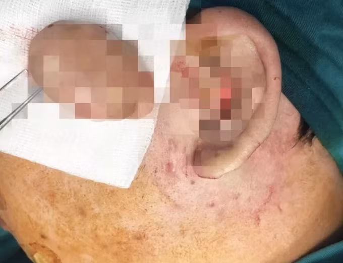 Nam sinh bien dang “tai sup lo” vi thich deo khuyen cho 