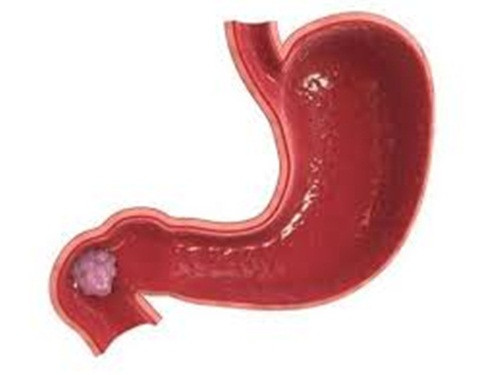 Những chất này là yếu tố gây bệnh ung thư dạ dày hay ung thư thực quản rất nhanh. Một số loại thực phẩm khác có mùi này như cá muối, thịt xông khói, các loại thịt muối.