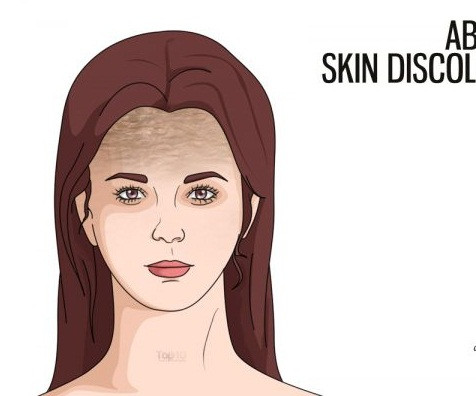 Da đổi màu bất thường ở một vùng. Biểu hiện này có thể là bệnh buồng trứng đa nang (PCOS ). Da sẽ đổi màu trên cổ, trán, rốn, nách và ngực. Lượng insulin cao ở những người mắc PCOS sẽ gây ra dấu hiệu này. Những người có tiền sử người nhà bệnh này lại càng phải cẩn thận hơn.