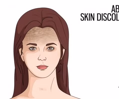 Da đổi màu bất thường ở một vùng. Biểu hiện này có thể là bệnh buồng trứng đa nang (PCOS ). Da sẽ đổi màu trên cổ, trán, rốn, nách và ngực. Lượng insulin cao ở những người mắc PCOS sẽ gây ra dấu hiệu này. Những người có tiền sử người nhà bệnh này lại càng phải cẩn thận hơn.