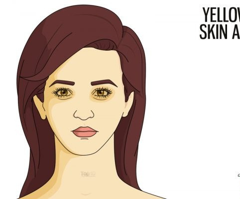 Vàng da vùng mắt. Nếu da vùng mắt đột ngột đổ vàng chạch thì có thể là hậu quả của tế bào máu chết. Bình thường những tế bào này phải được bài tiết qua đường tiêu hóa.