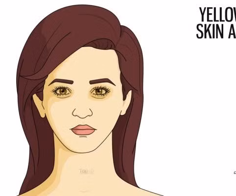 Vàng da vùng mắt. Nếu da vùng mắt đột ngột đổ vàng chạch thì có thể là hậu quả của tế bào máu chết. Bình thường những tế bào này phải được bài tiết qua đường tiêu hóa.