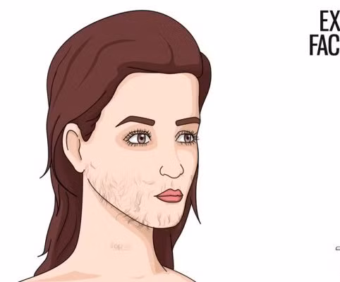 Mọc râu ở mặt. Không tính đến ria mép, bỗng một ngày bạn thấy lún phún vài sợi râu ở cằm, quai hàm …thì có thể đã mắc bệnh phụ khoa như u nang buồng trứng.