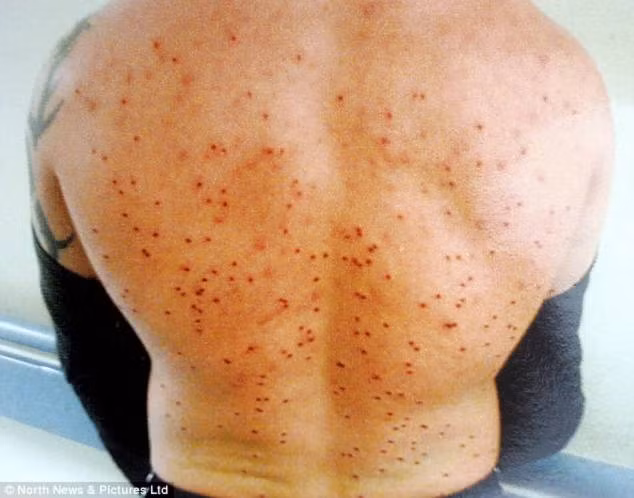 Các bác sĩ cũng chẩn đoán những chấn thương nghiêm trọng này sẽ khiến anh Clarke giảm ít nhất 25 năm tuổi thọ. Mặc dù đã may mắn sống sót, nhưng anh Clarke vẫn hàng ngày phải chịu những cơn đau đớn do ảnh hưởng của những viên đạn găm trong người.