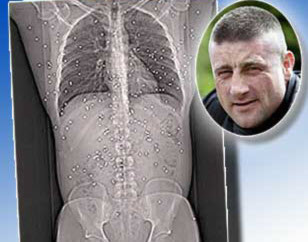 Anh Clarke ở Anh cũng đã bị trúng hơn 150 viên đạn. Tuy nhiên, các bác sĩ không thể lấy các viên đạn này ra khỏi cơ thể của anh bởi một số viên đạn nằm trong những bộ phận quan trọng.