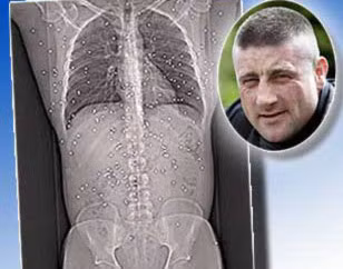 Anh Clarke ở Anh cũng đã bị trúng hơn 150 viên đạn. Tuy nhiên, các bác sĩ không thể lấy các viên đạn này ra khỏi cơ thể của anh bởi một số viên đạn nằm trong những bộ phận quan trọng.