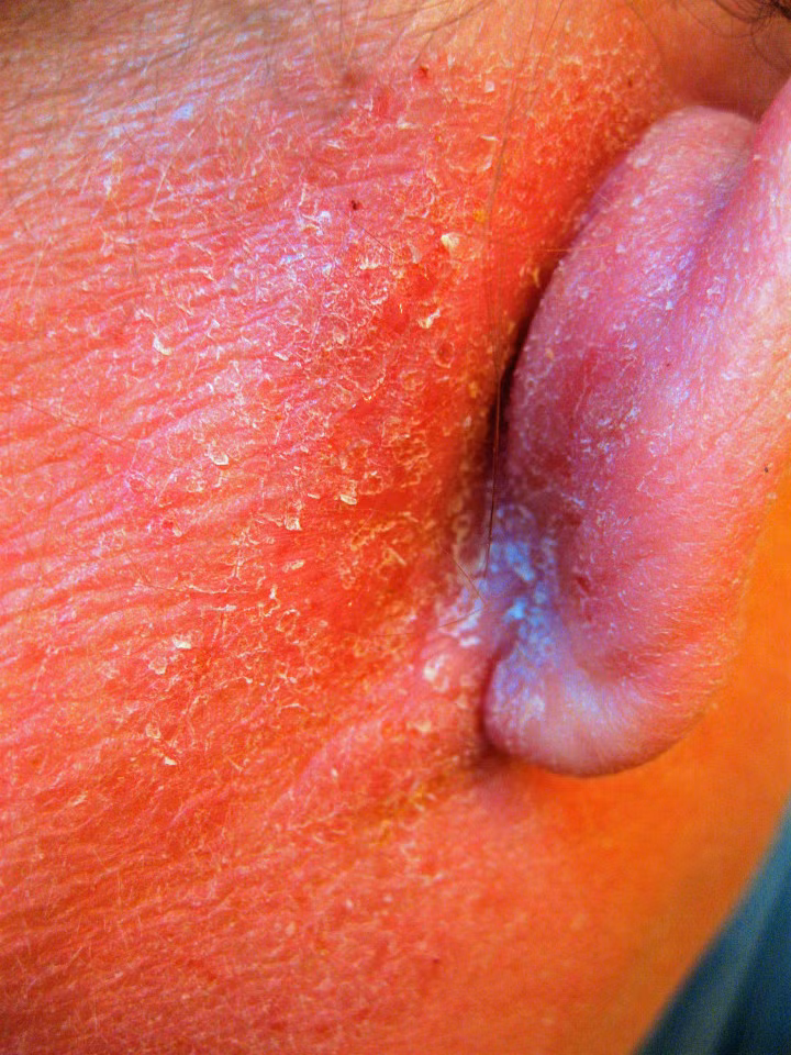 Da cô liên tục bị bong tróc và rơi ra từng tảng, ra da non và sau đó lặp lại chu kỳ. “Da tôi đỏ ửng như quả cà chua bở bóc vỏ. Tôi thấy ngứa rát như hàng trăm con ong đang chích mà không thể gãi”.