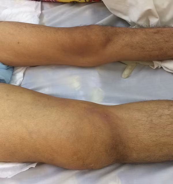 Benh truyen nhiem nguy hiem Whitmore hiem cuc nguy hiem