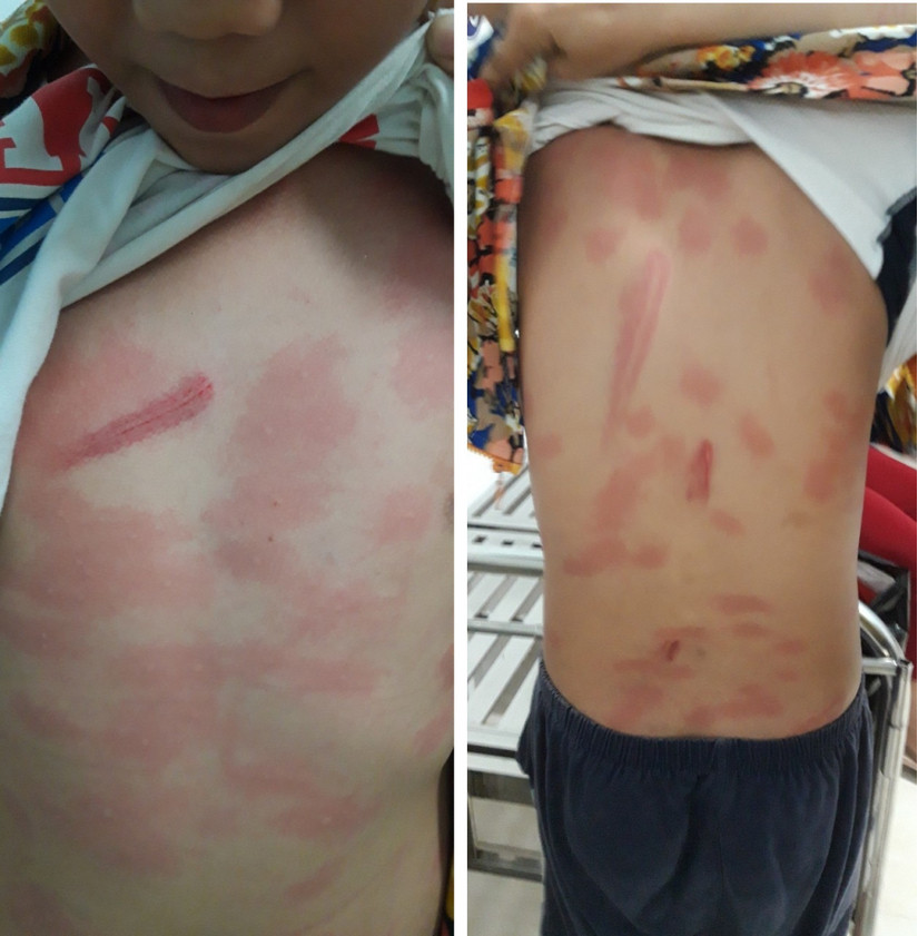 Be trai 13 tuoi chi chit vet thuong vi bi co ruot danh het suc tan nhan