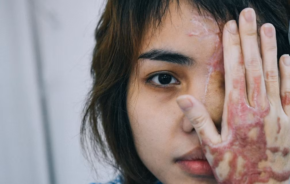 Vy kể: "Chỉ cần bạn bè tôi ai đó lên mạng xã hội khen tôi xinh hoặc trêu đùa là anh ấy liền nhắn tin đe doạ. Không dừng lại Hải còn đánh đập tôi nhiều lần khiến tôi cảm thấy bất an khi gần anh ta”. Bực tức vì chuyện này, Hải đến một cửa hàng mua axit rồi hẹn qua nhà Vy nói chuyện.