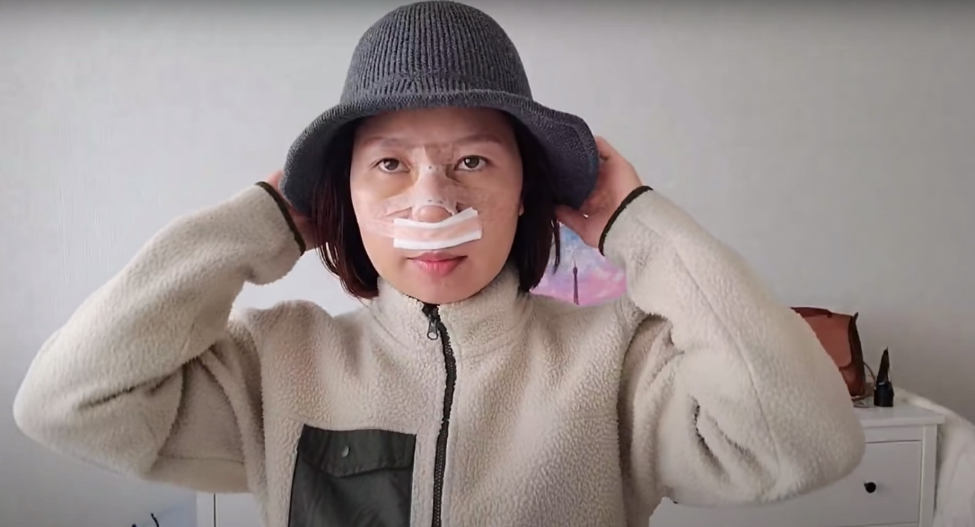 Cũng giống các Youtuber ẩm thực khác, cô đã thẩm mỹ chỉnh lại dáng mũi sau hơn 3 năm làm YouTuber và kiếm được kha khá.