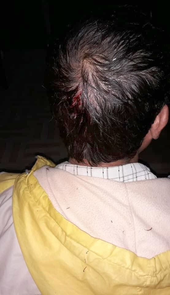 Nhiều người bị thương sau trận mưa đá.