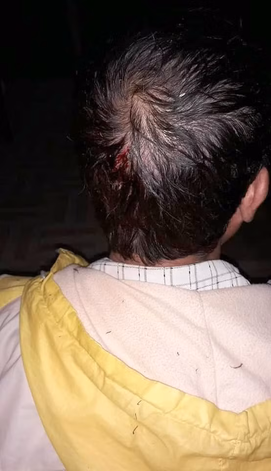 Nhiều người bị thương sau trận mưa đá.