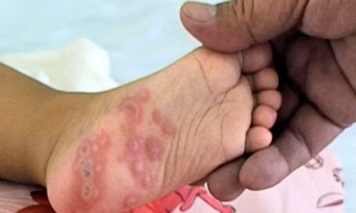 Canh bao benh tay chan mieng bung phat mua khai truong