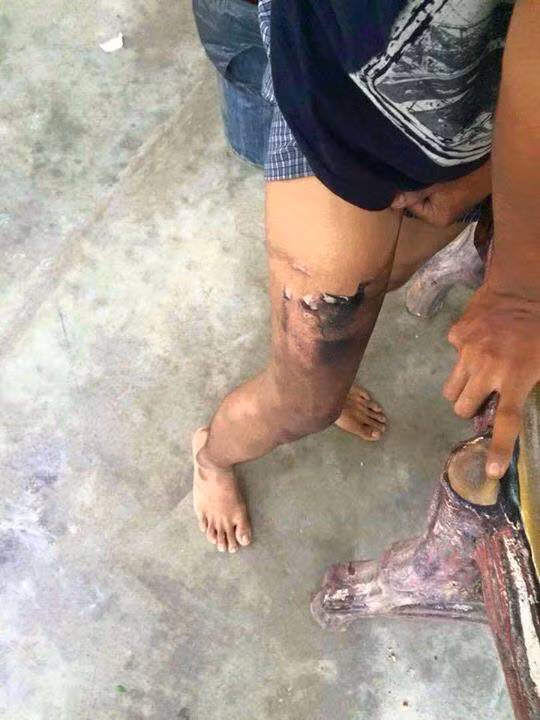 Nguyên nhân của sự việc là do trước đó chiếc điện thoại đã được chủ nhân sử dụng khá nhiều, được đặt trong chiếc quần jeans chật nên pin điện thoại đã phồng lên rồi phát nổ. Sự cố đã khiến một bên chân của nam thanh niên bị bỏng rát khá nghiêm trọng.