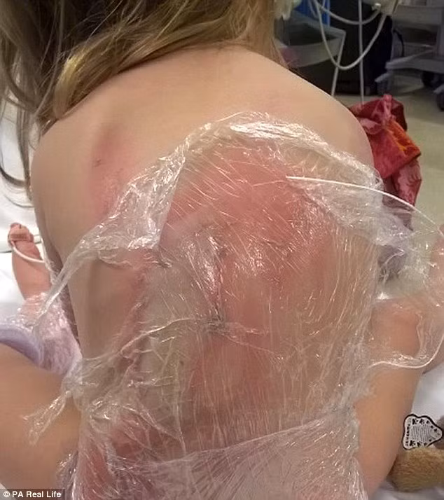 Các bác sĩ chẩn đoán bé Bella bị bỏng độ 2. Vết bỏng lan rộng 10% cơ thể bao gồm phần da ở lưng, mông, khuỷu tay và bắp chân trái.