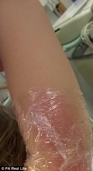 Các bác sĩ phải lấy da ở đùi để che vết thương trên lưng và cánh tay bé. 