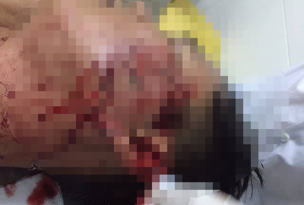 Dai uy cong an bi 8X dap coc bia vao mat gay thuong tich 15%