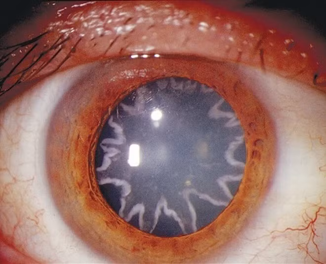 8. Con mắt của một thợ điện sau khi trải qua hơn 14.000 lần bị điện giật.