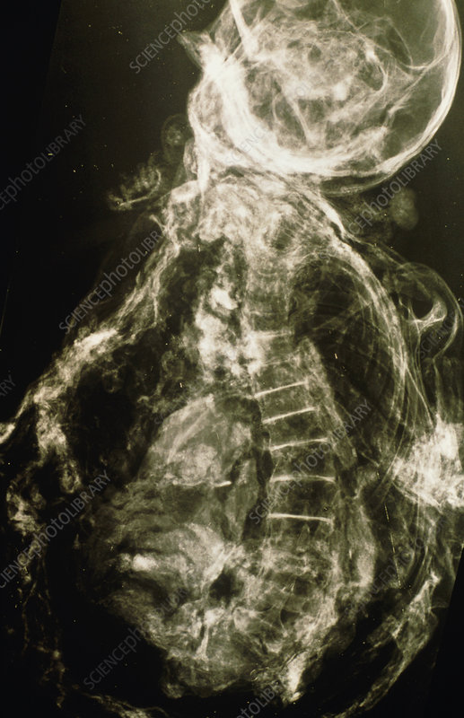 Cô gái Yde có chứng vẹo cột sống làm suy nhược cơ thể, bàn chân phải sưng tấy dẫn đến đi khập khiễng.