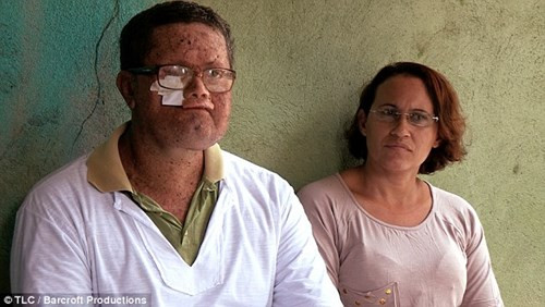 Một người nông dân tên Deide cũng bị mất đi phần lớn khuôn mặt do căn bệnh không thuốc chữa.