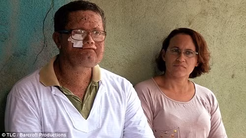 Một người nông dân tên Deide cũng bị mất đi phần lớn khuôn mặt do căn bệnh không thuốc chữa.