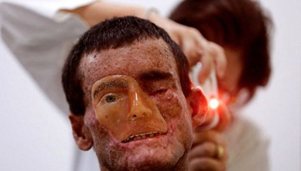 Trong số 800 dân sống ở Araras, có 600 người mắc căn bệnh lạ Xeroderma Pigmentosum (XP). Anh Djalma Jardin là 1 trong số đó. Anh chỉ còn 1 mắt, khuôn mặt biến dạng khiến anh không thể nhắm được mắt còn lại.