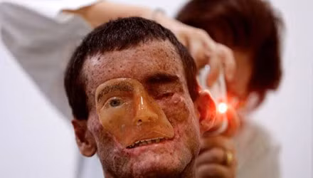 Trong số 800 dân sống ở Araras, có 600 người mắc căn bệnh lạ Xeroderma Pigmentosum (XP). Anh Djalma Jardin là 1 trong số đó. Anh chỉ còn 1 mắt, khuôn mặt biến dạng khiến anh không thể nhắm được mắt còn lại.